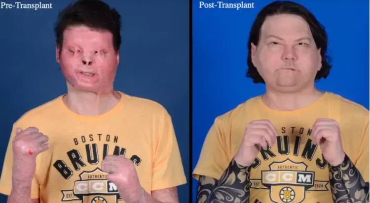 O primeiro transplante de rosto e mãos é realizado com sucesso