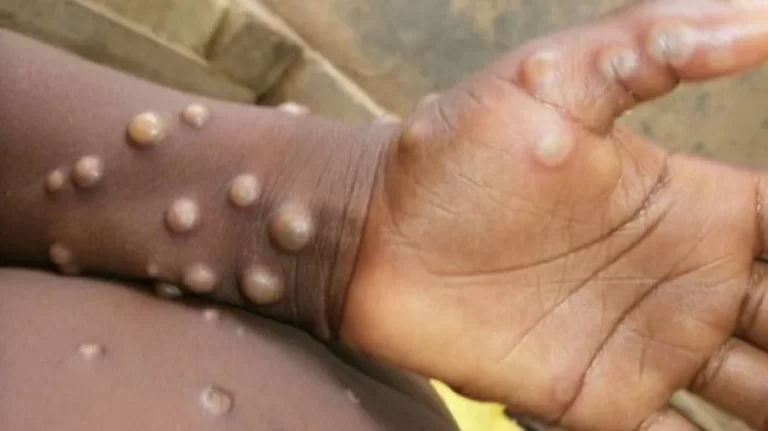 Piauí Registrou Mais Um Caso De Váriola Dos Macacos (Monkeypox), Subindo Para Quatro, Já Foram Notificados 72 Casos Da Doença